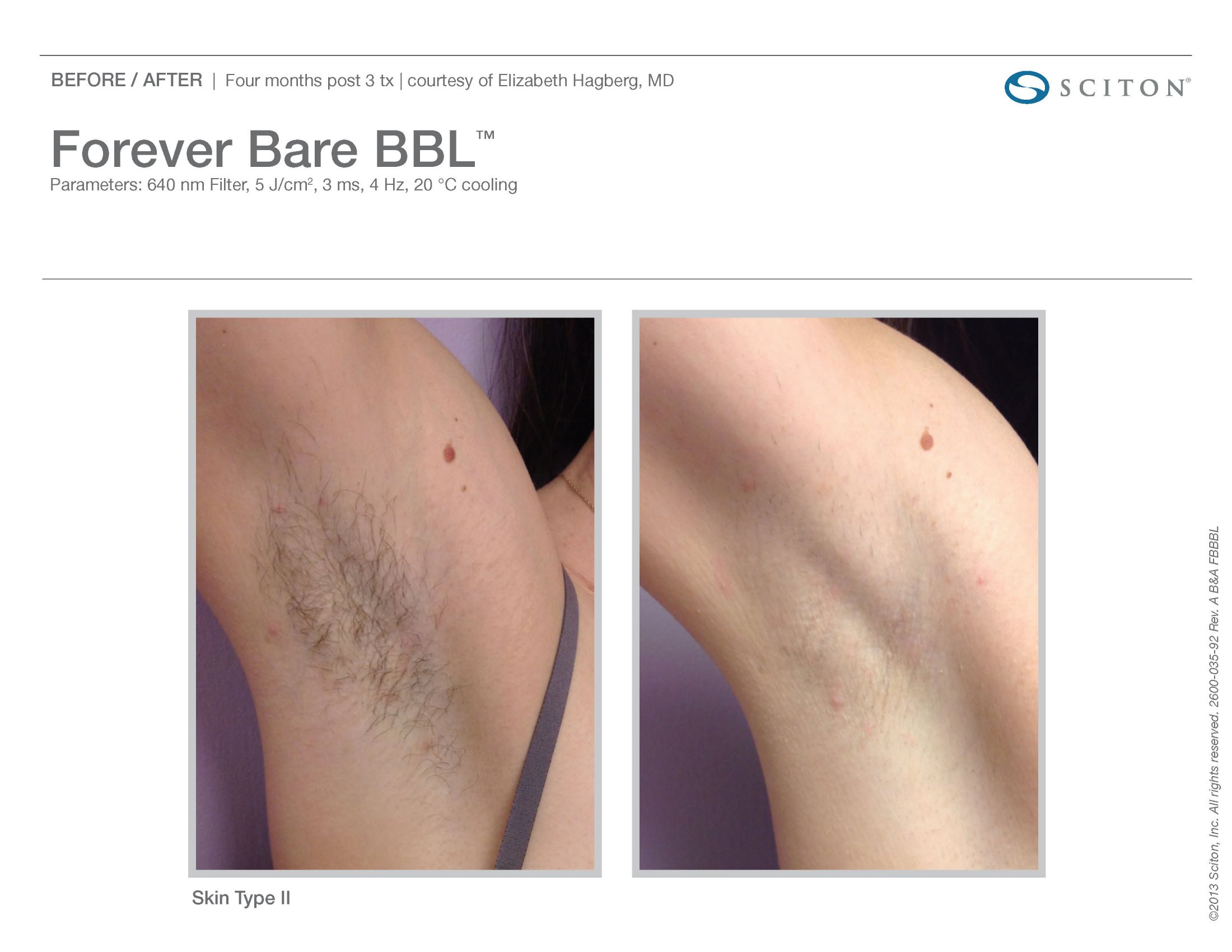 Laser Hair Removal St. Louis MO